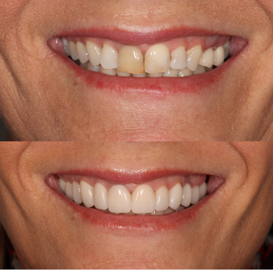 before and after of 12 dental crowns