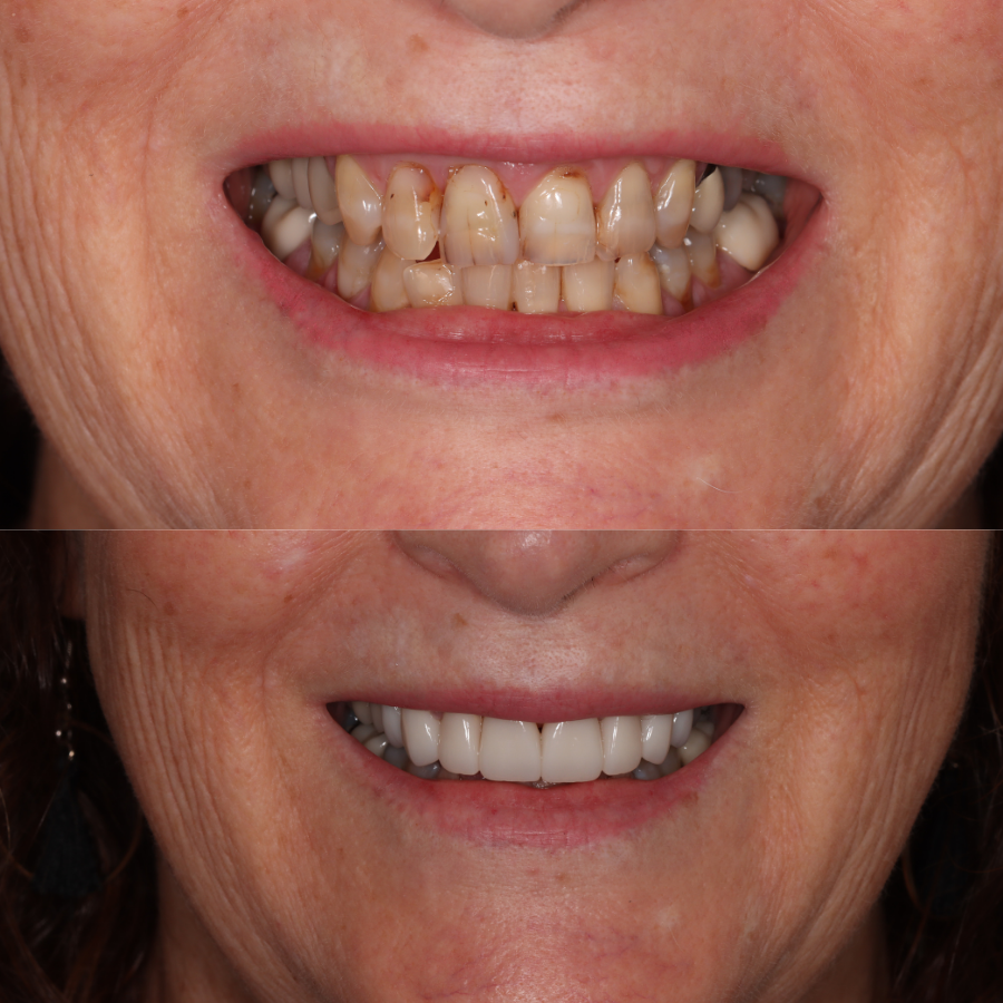 Before and after results from 8 upper crowns