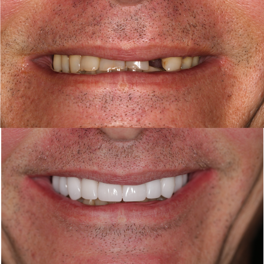before and after results from teeth Crowns