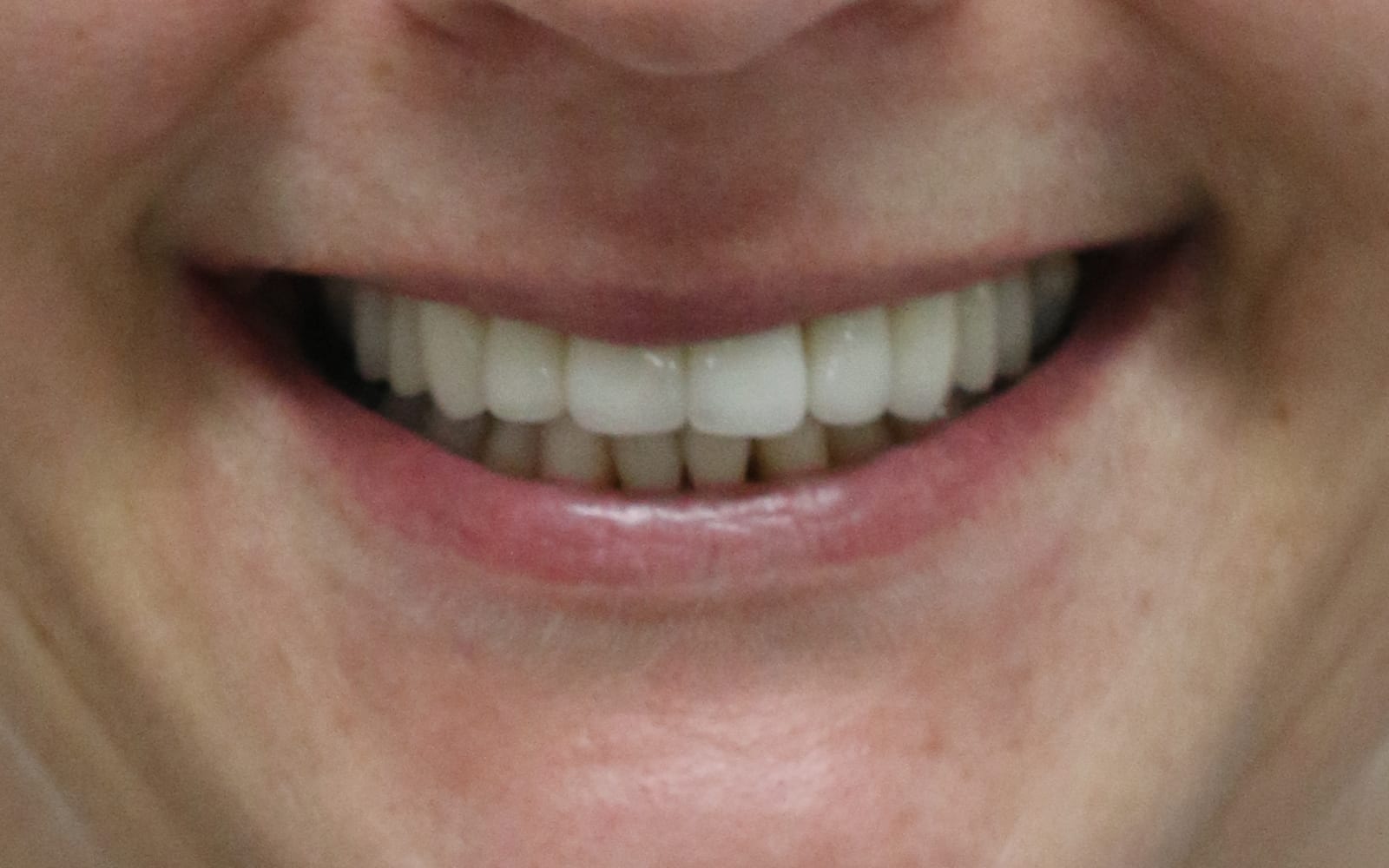 Before & Afters Fix Dental Mount Gravatt & Chermside