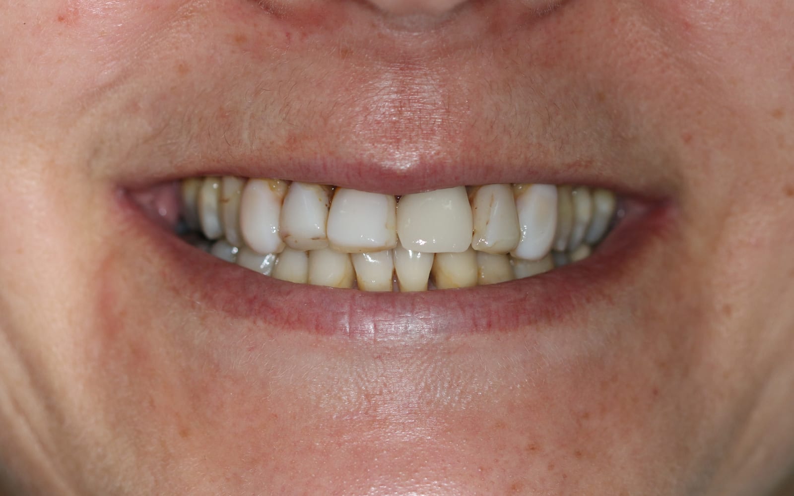Before & Afters Fix Dental Mount Gravatt & Chermside