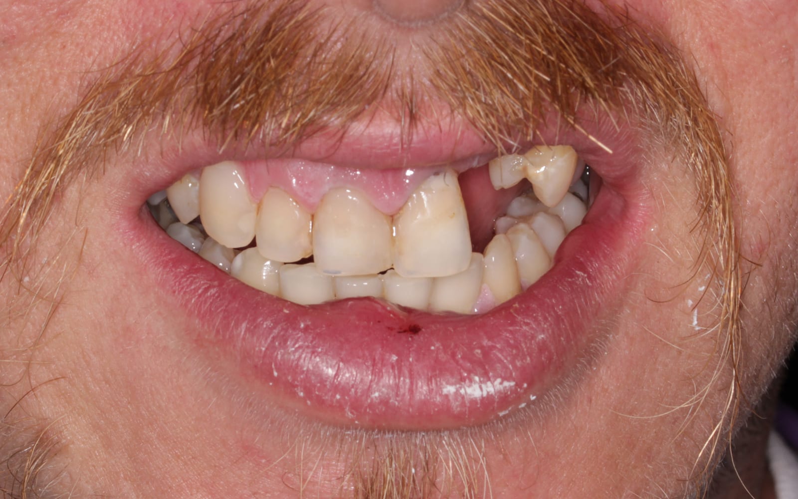 Before & Afters Fix Dental Mount Gravatt & Chermside