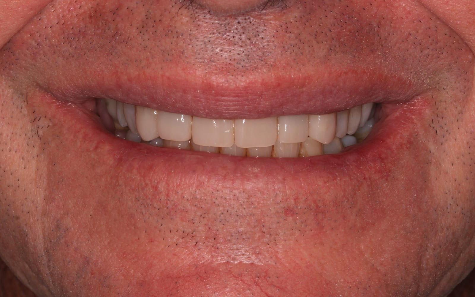Before & Afters Fix Dental Mount Gravatt & Chermside