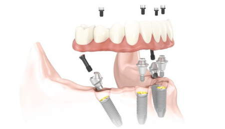 All-on-4 Implants Fix Dental 450x258