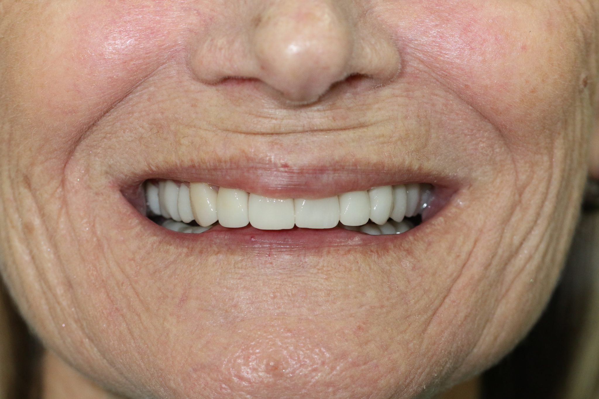 Before & Afters Fix Dental Mount Gravatt & Chermside