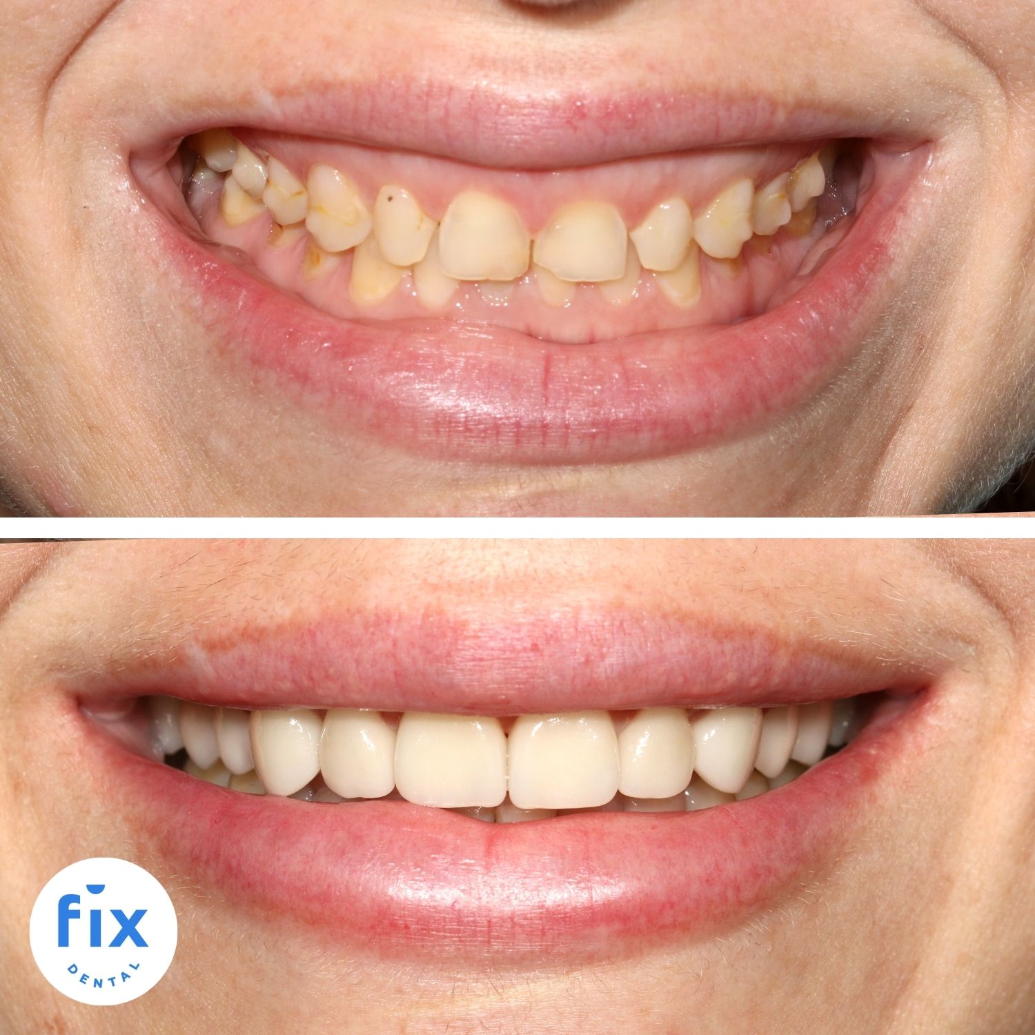 Fix Dental Brisbane Dental Veneers before and after image