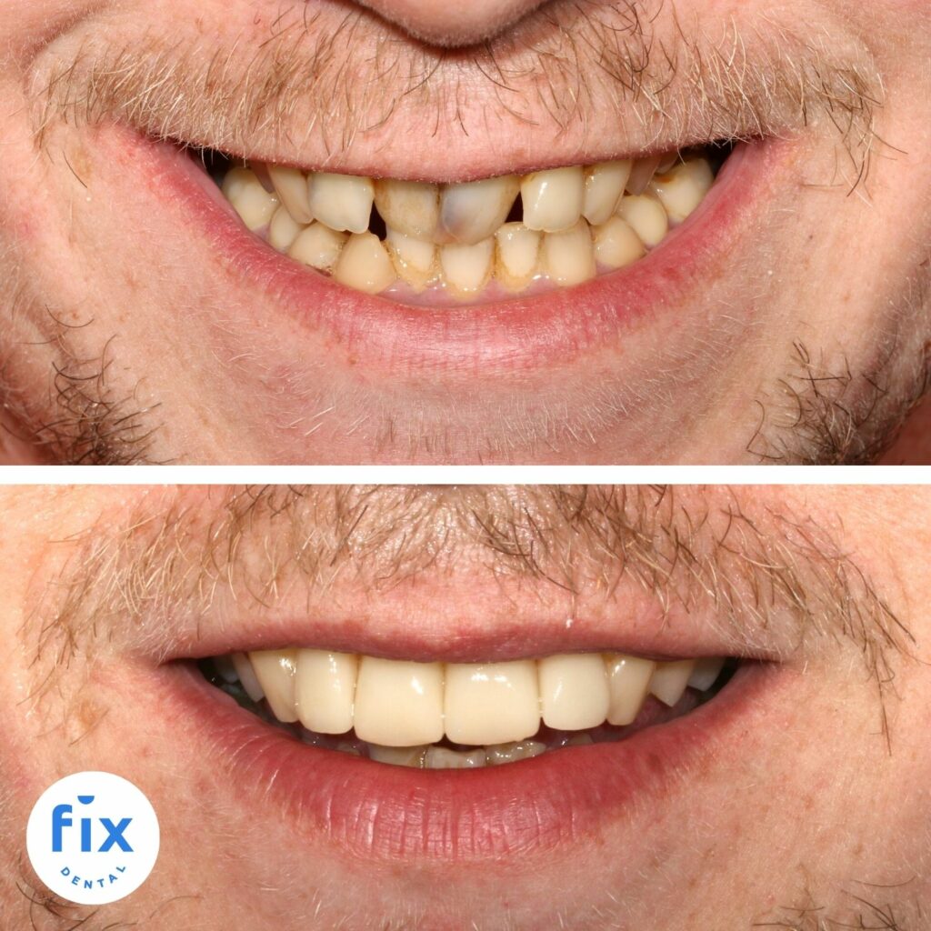 Dental Veneers Fix Dental Mount Gravatt & Chermside