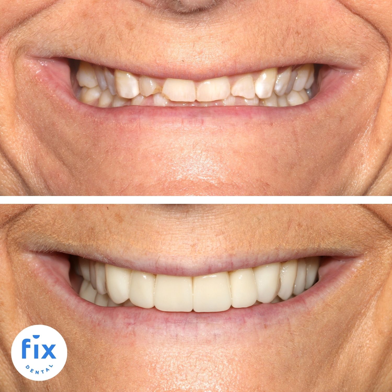 Fix Dental Brisbane Dental Veneers before and after image