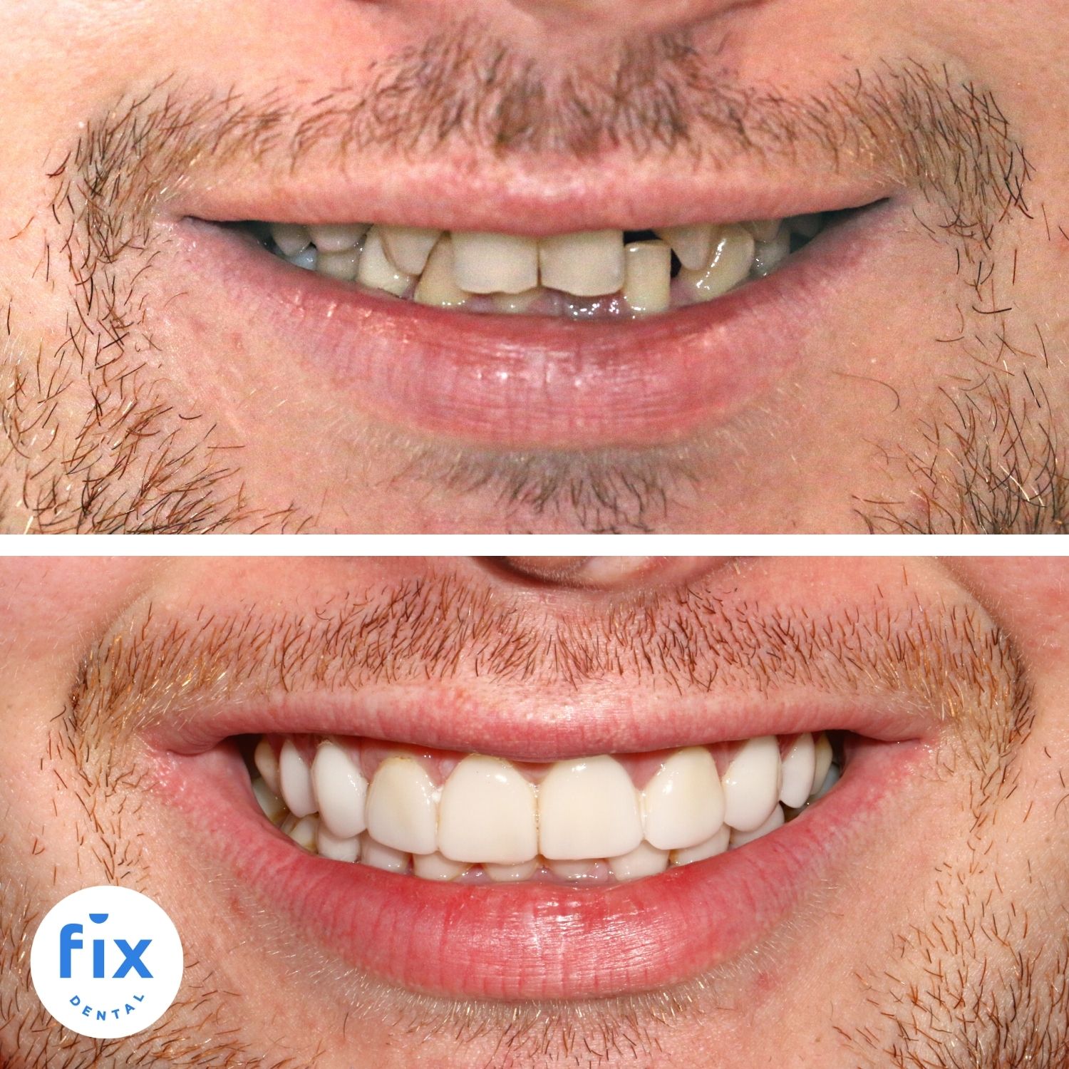 Fix Dental Brisbane Dental Veneers before and after image