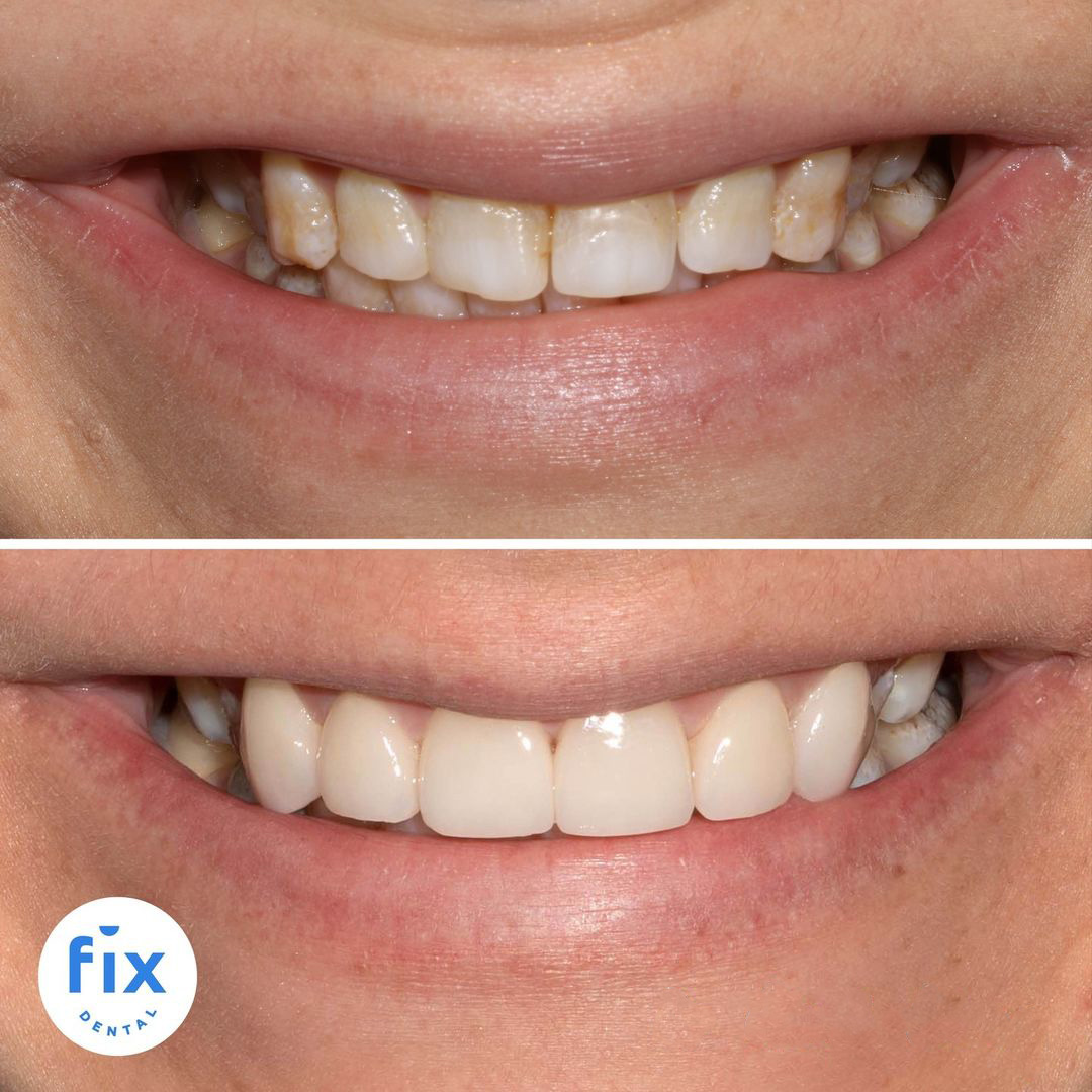 Fix Dental Brisbane Dental Veneers before and after image