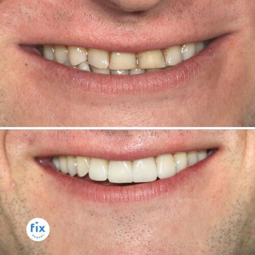 Dental Veneers Fix Dental Mount Gravatt & Chermside