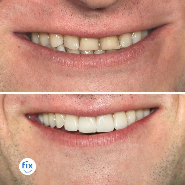 Fix Dental Brisbane Veneers before and after image