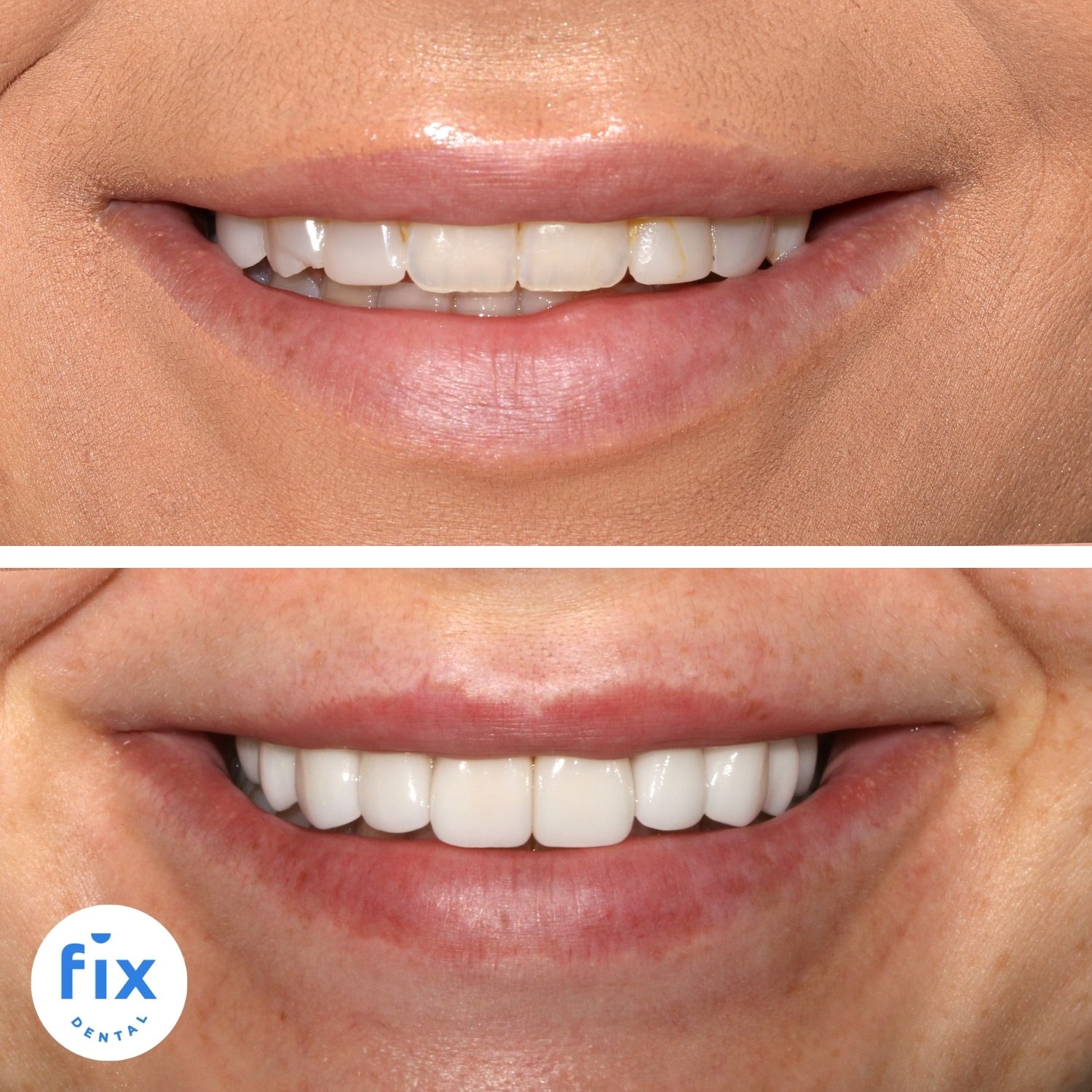 Fix Dental Brisbane Veneers before and after image