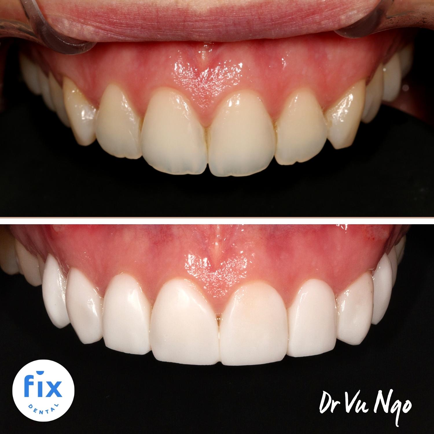 Dental Veneers Fix Dental Mount Gravatt & Chermside