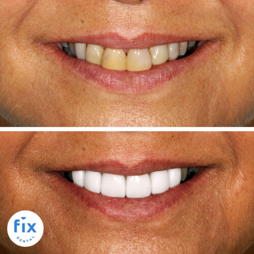 Dental Veneers Fix Dental Mount Gravatt & Chermside