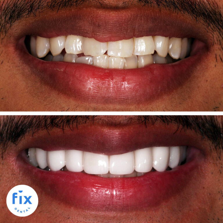 Dental Veneers Fix Dental Mount Gravatt & Chermside