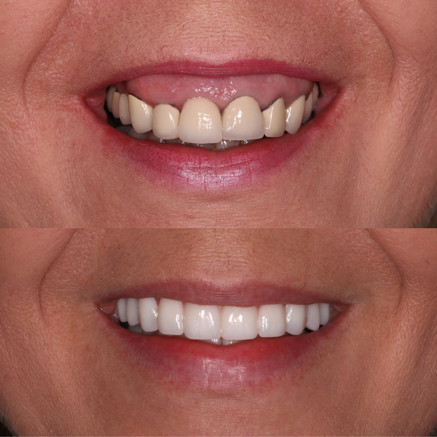 All-on-four treatment before and after photo