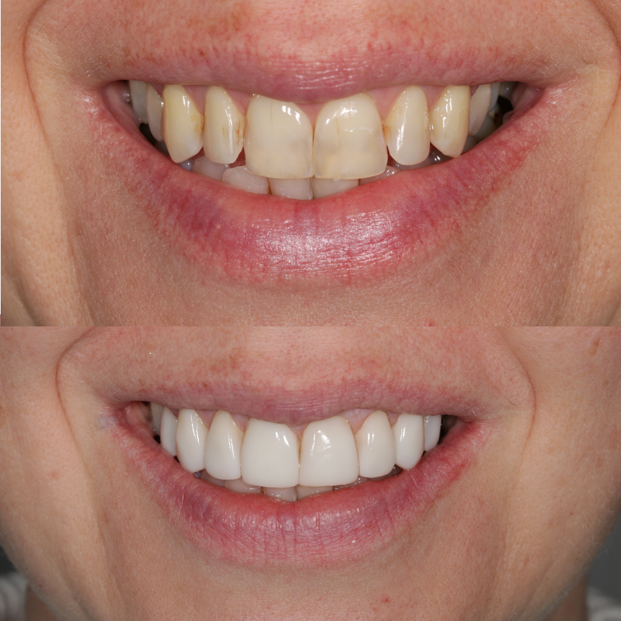 Before and after photo of 8 composite veneers