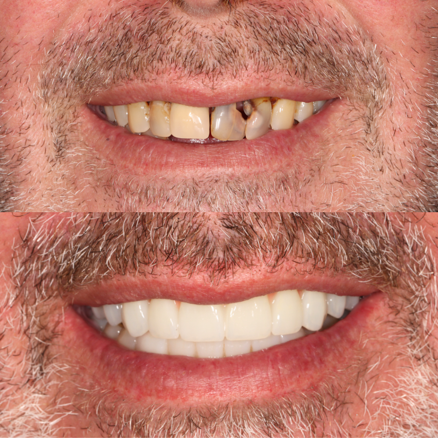 before and after photo of an all-on-four dental treatment