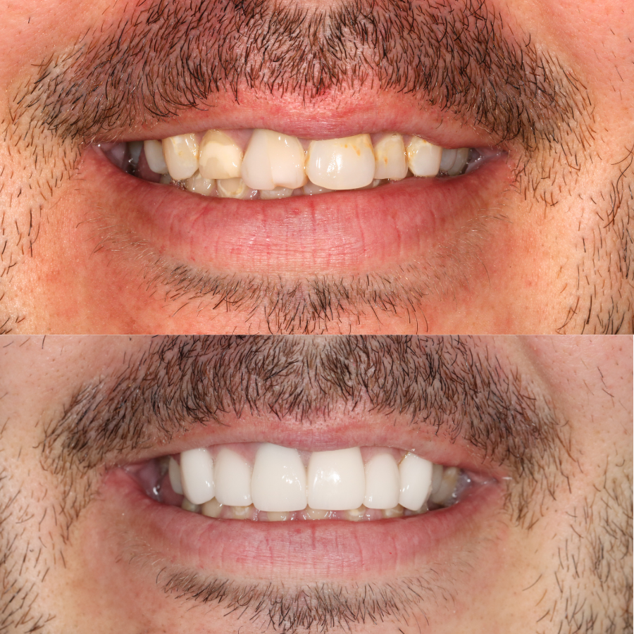 porcelain veneers before and after