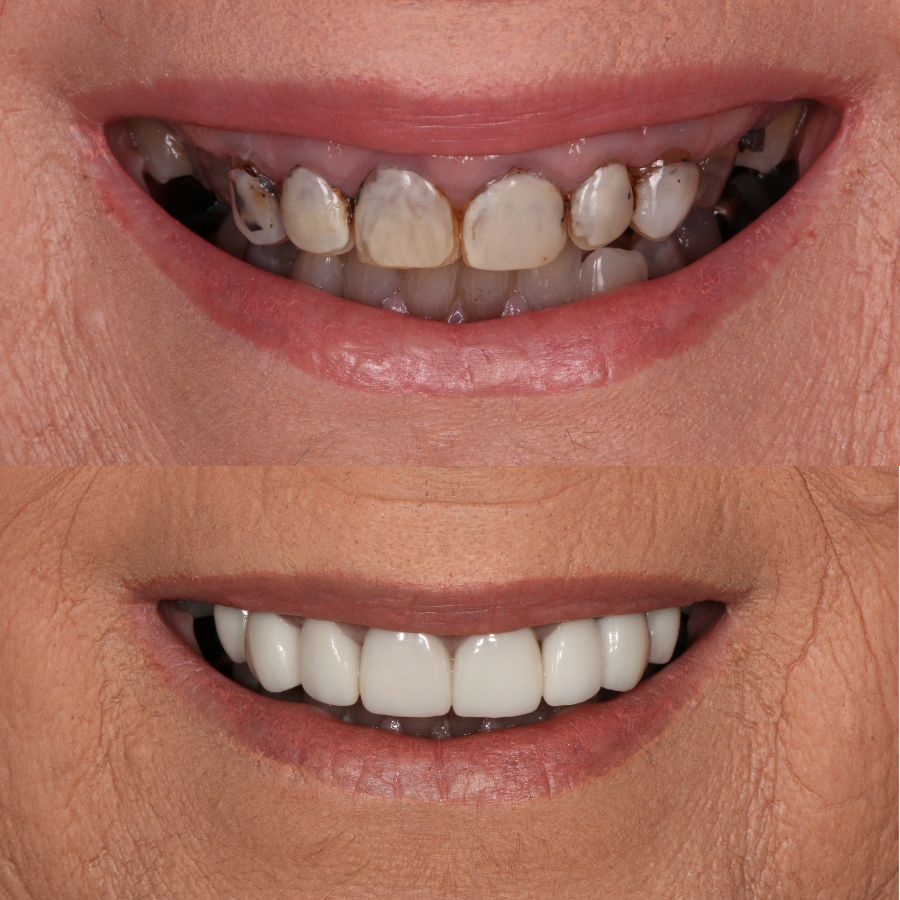 porcelain veneers before and after