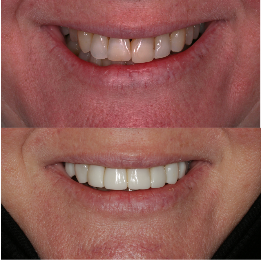 Before and after results of composite veneers
