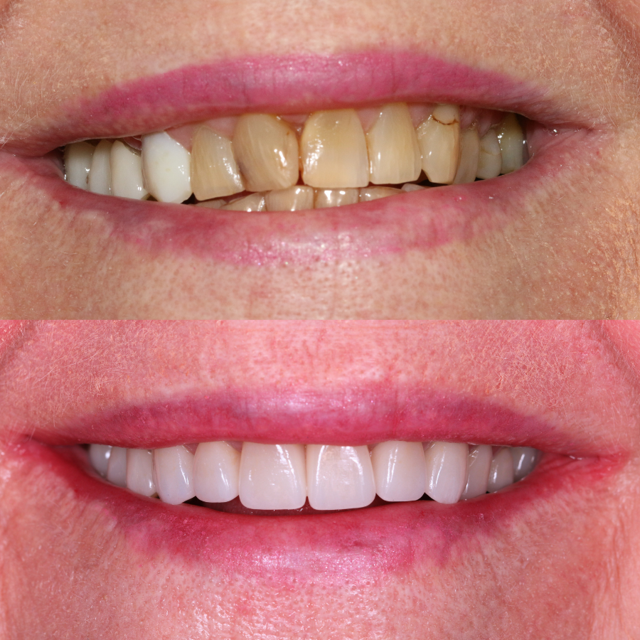 porcelain veneers before and after