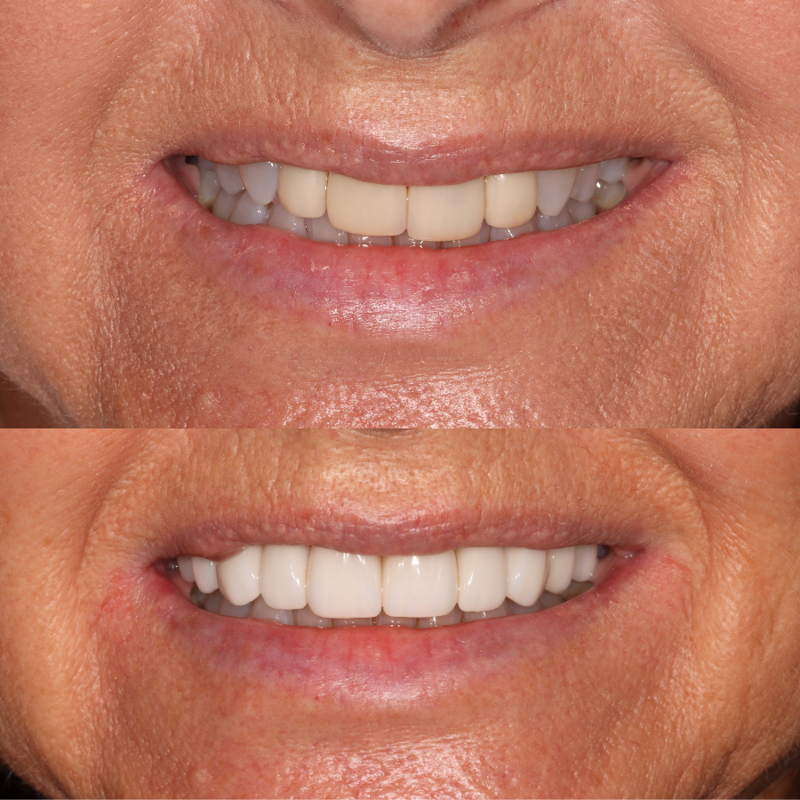 porcelain veneers before and after