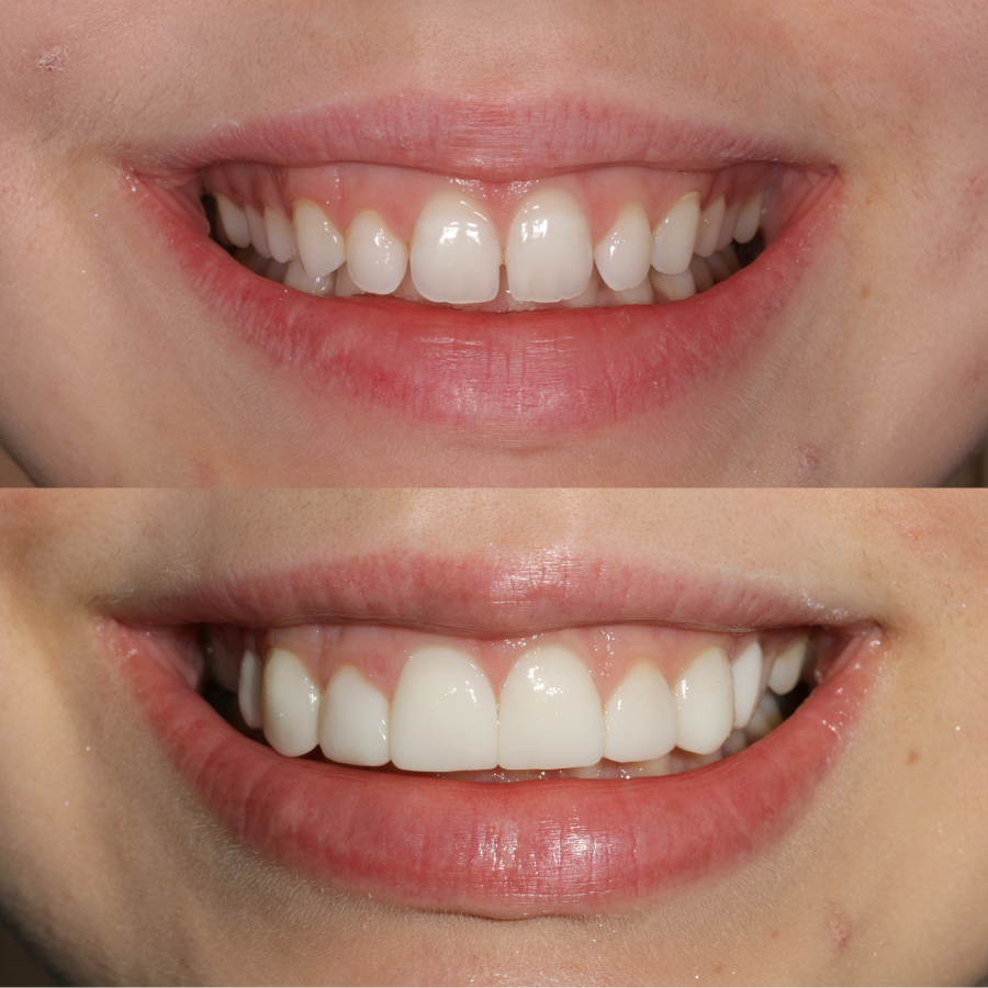 8 upper composite veneers before and after
