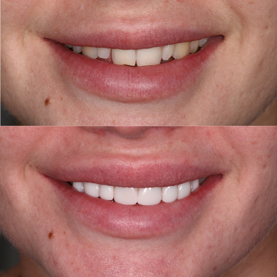 8 upper composite veneers before and after
